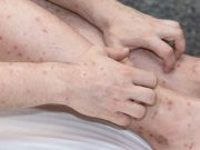 LE MINISTÈRE DE LA SANTÉ EXHORTE DES MESURES DE PRÉVENTION : Alerte à la gale dans les écoles