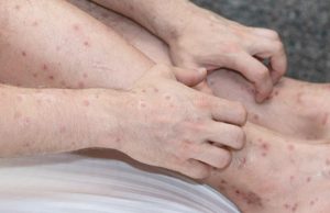 LE MINISTÈRE DE LA SANTÉ EXHORTE DES MESURES DE PRÉVENTION : Alerte à la gale dans les écoles