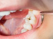 Caries dentaires : Le dispositif de santé scolaire renforcé à Oran