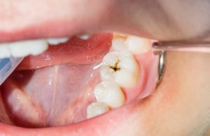 Caries dentaires : Le dispositif de santé scolaire renforcé à Oran